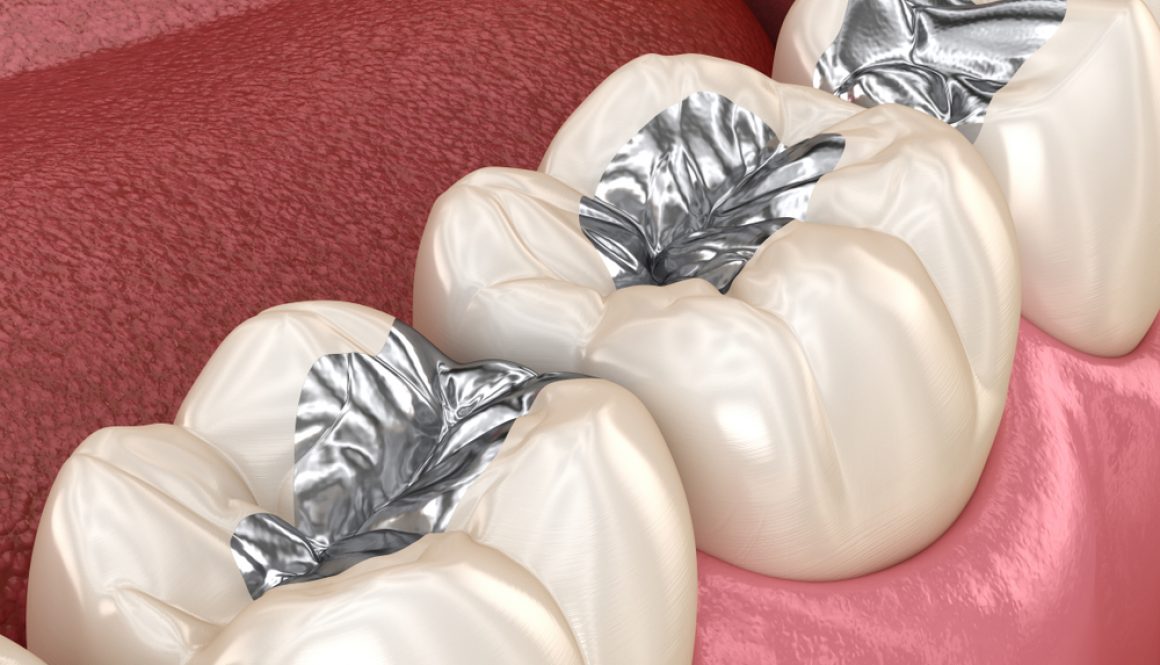 You may have heard that metal fillings come with risks; get the facts you should know.