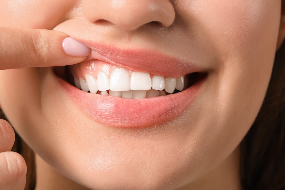 is-gum-disease-affecting-your-smile