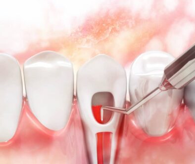 the-signs-you-may-need-root-canal-therapy