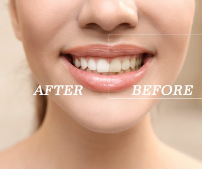 teeth-whitening-stain-types-and-treatment-options