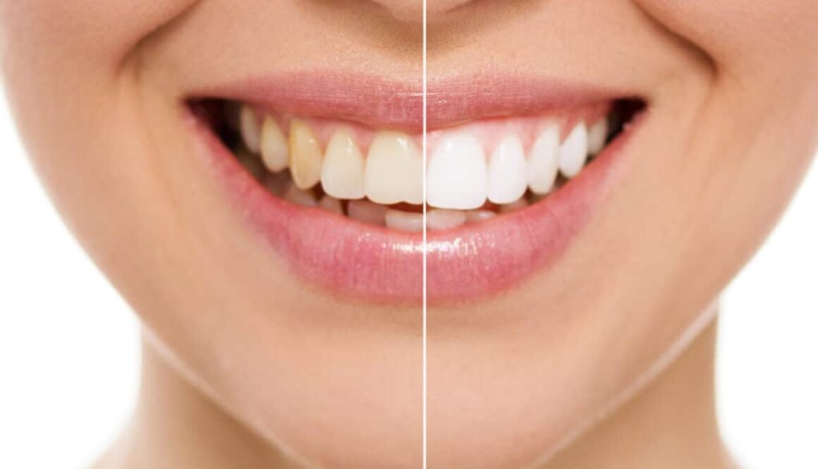 5-benefits-of-teeth-whitening