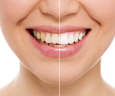 5-benefits-of-teeth-whitening