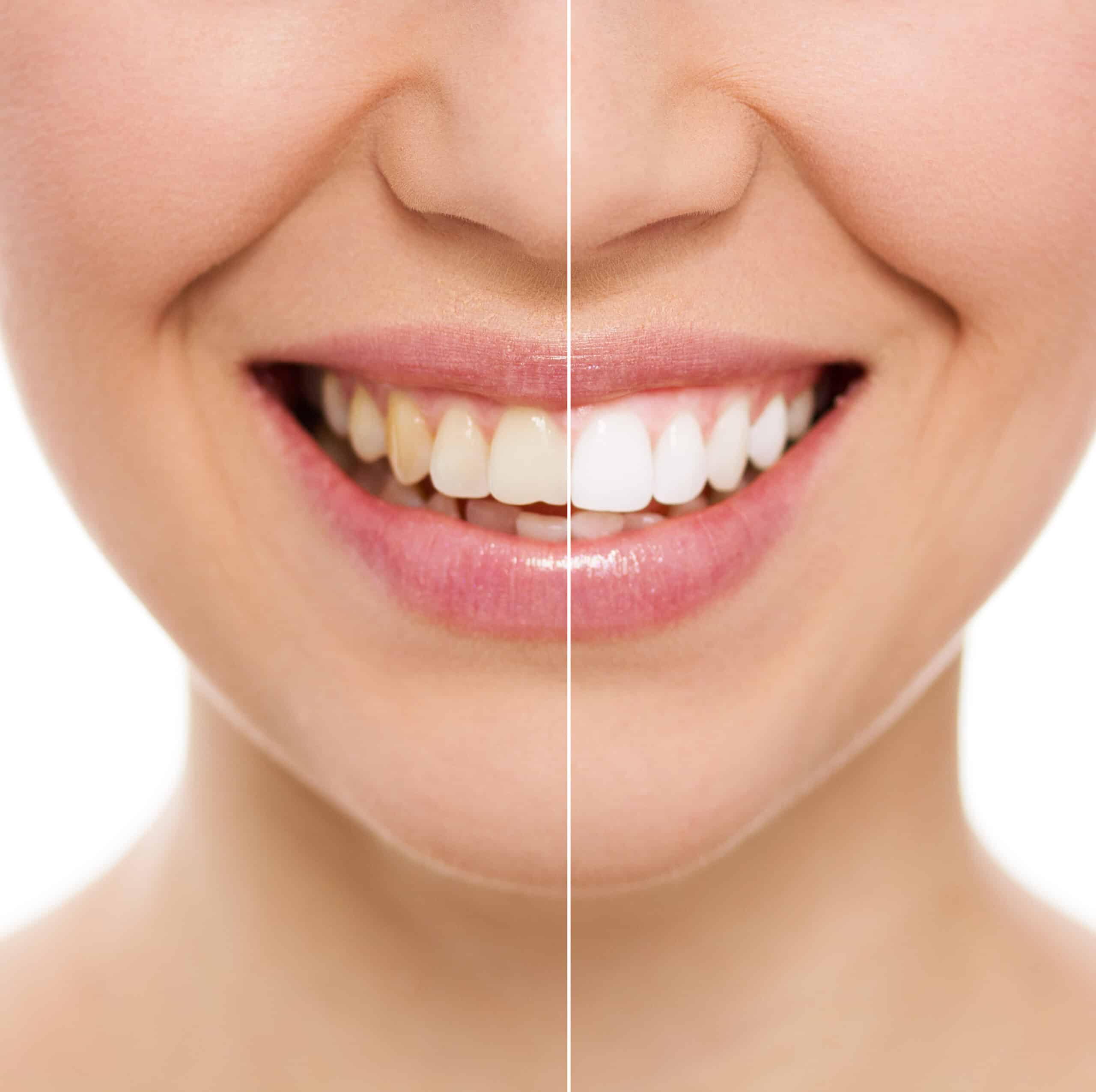 5-benefits-of-teeth-whitening
