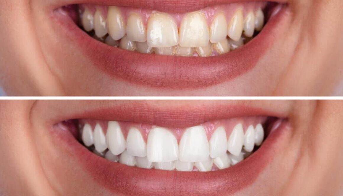 unlock-your-smiles-radiance-exploring-the-top-benefits-of-teeth-whitening