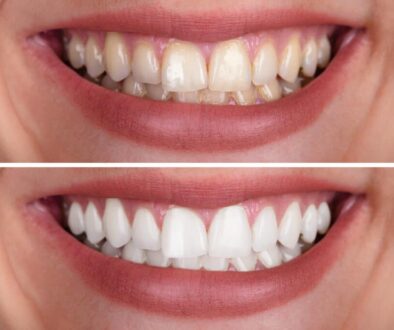 unlock-your-smiles-radiance-exploring-the-top-benefits-of-teeth-whitening
