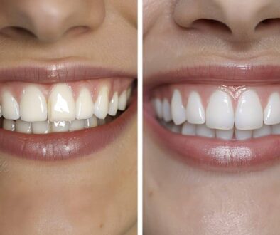 the-process-of-getting-veneers-with-young-family-dental