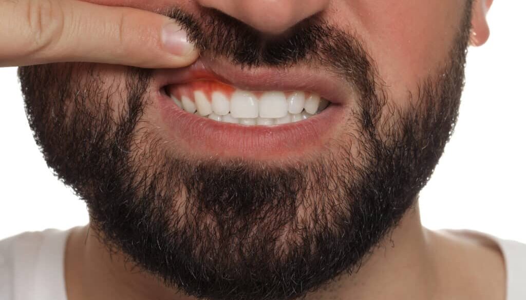 how-gum-disease-affects-your-oral-health-what-to-know-from-young-family-dental-highland