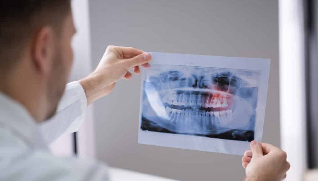 when-to-remove-wisdom-teeth-in-saratoga-springs