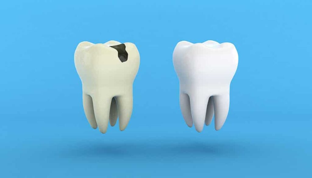 why-early-treatment-for-tooth-decay-matters-for-herriman-patients